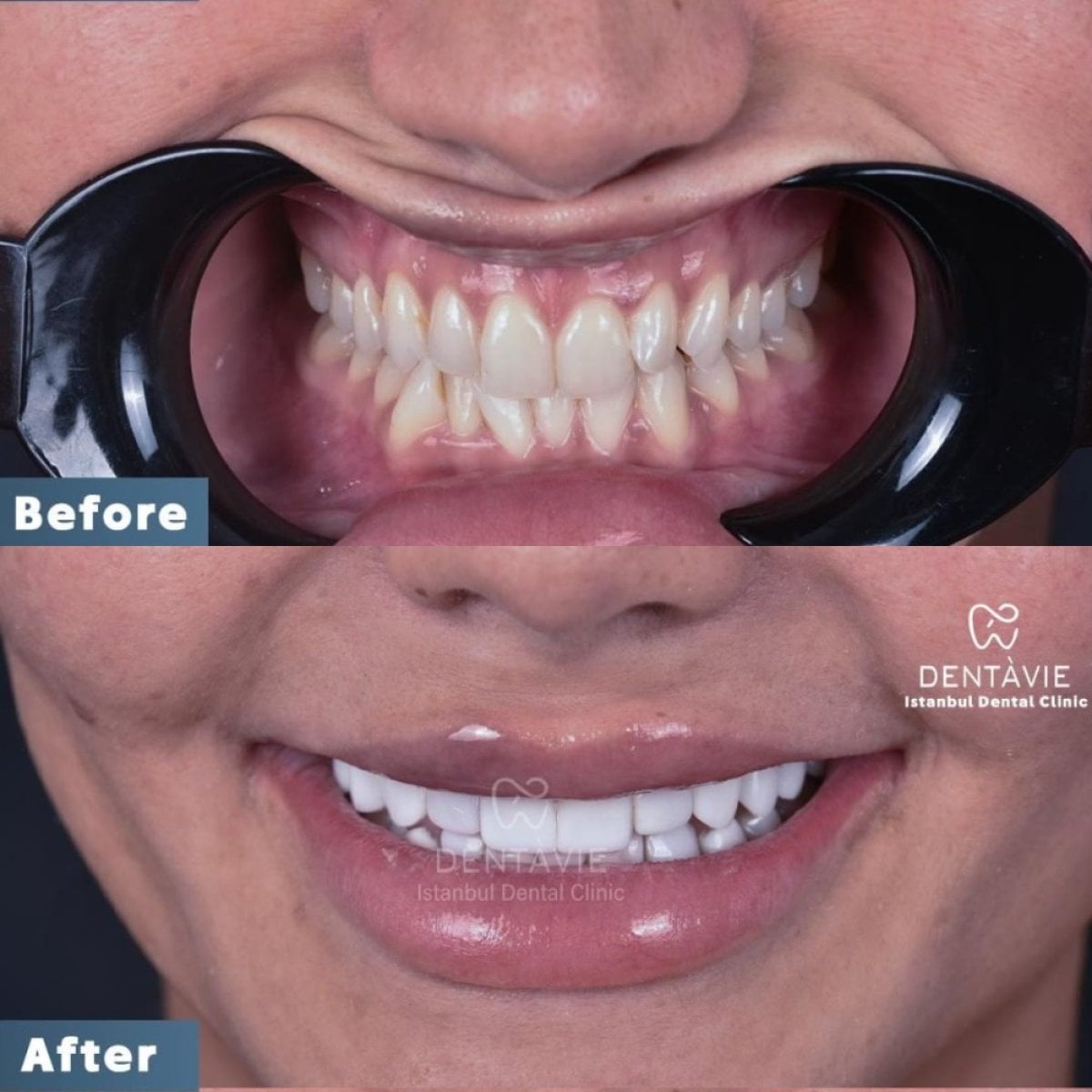 نتائج قبل وبعد ابتسامة هوليود في Dentavie Istanbul Dental Clinic، تجميل الابتسامة