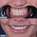 Resultados antes y después de Hollywood Smile en Dentavie Istanbul Dental Clinic, cambio de sonrisa