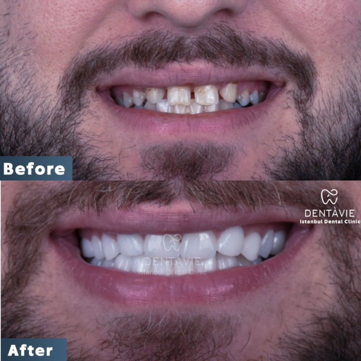 Resultados antes y después de Hollywood Smile en Dentavie Istanbul Dental Clinic, cambio de sonrisa