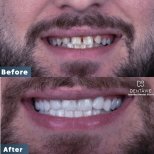 Hollywood Smile before and after results at Dentavie Istanbul Dental Clinic, smile makeover