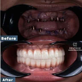Before and after All-on-6 dental implants result at Dentavie Istanbul Dental Clinic, full smile