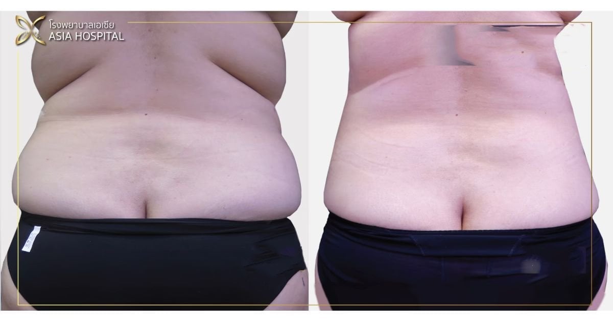 Vorher-nachher-Liposuktionsergebnis bei Asia Cosmetic Hospital, sichtbare Taillenkontur