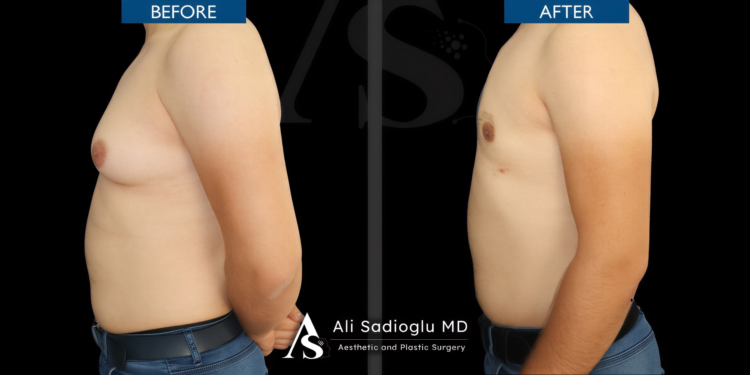 Resultados de liposucción 360 antes y después en Dr. Safa Manav Clinic, contorno mejorado