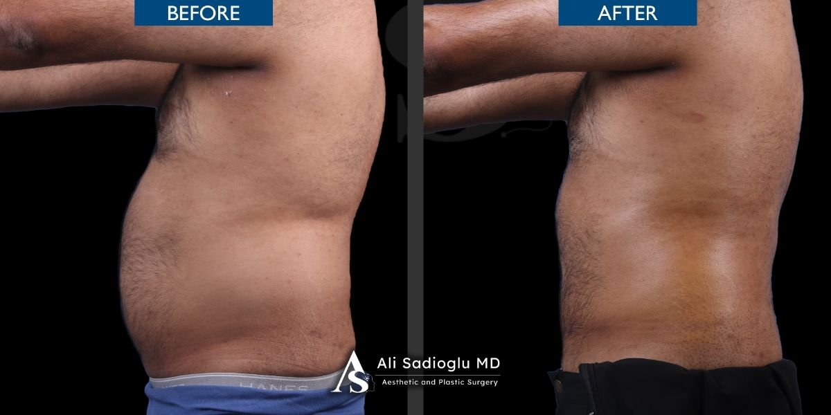 نتائج شفط الدهون 360 قبل وبعد في عيادة Dr. Safa Manav، تحسين شكل الجسم