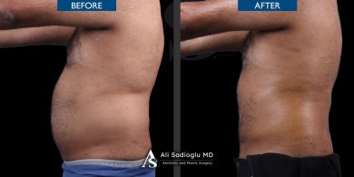 360 liposuction before and after results at Dr. Safa Manav Clinic, improved body contour