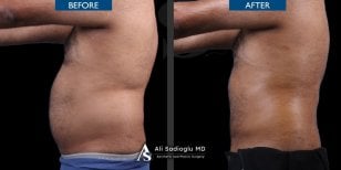 360 liposuction before and after results at Dr. Safa Manav Clinic, improved body contour