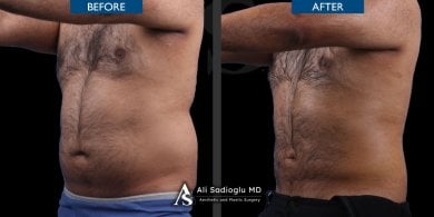 360 liposuction before and after results at Dr. Safa Manav Clinic, improved body contour