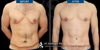 Before and after 360 liposuction results at Dr. Safa Manav Clinic, improved male body contour
