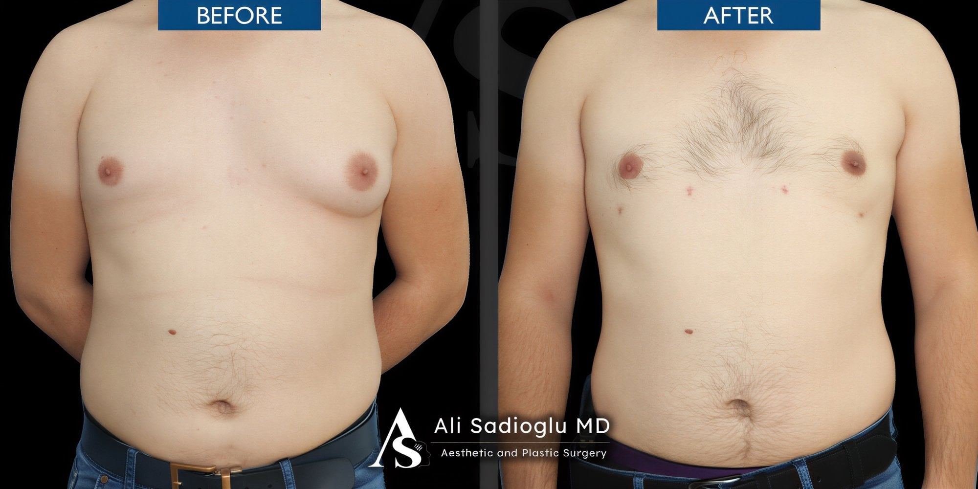 Resultados de liposucción 360 antes y después en Dr. Safa Manav Clinic, mejor contorno torácico