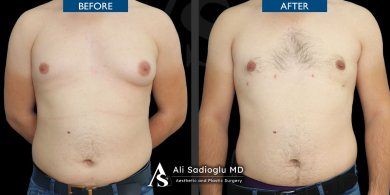Before and after 360 liposuction results at Dr. Safa Manav Clinic, improved male chest contour