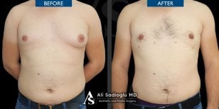 Before and after 360 liposuction results at Dr. Safa Manav Clinic, improved male chest contour