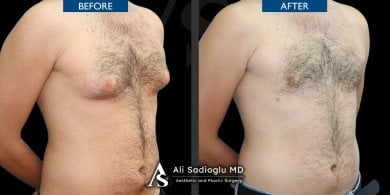 Gynecomastia surgery before and after results at Dr. Safa Manav Clinic, male chest contour