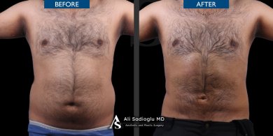 Before and after 360 liposuction results at Dr. Safa Manav Clinic, improved body contour