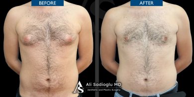Before and after 360 liposuction results at Dr. Safa Manav Clinic, improved male body contour
