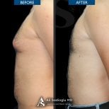 Before and after 360 liposuction results at Dr. Safa Manav Clinic, improved body contour
