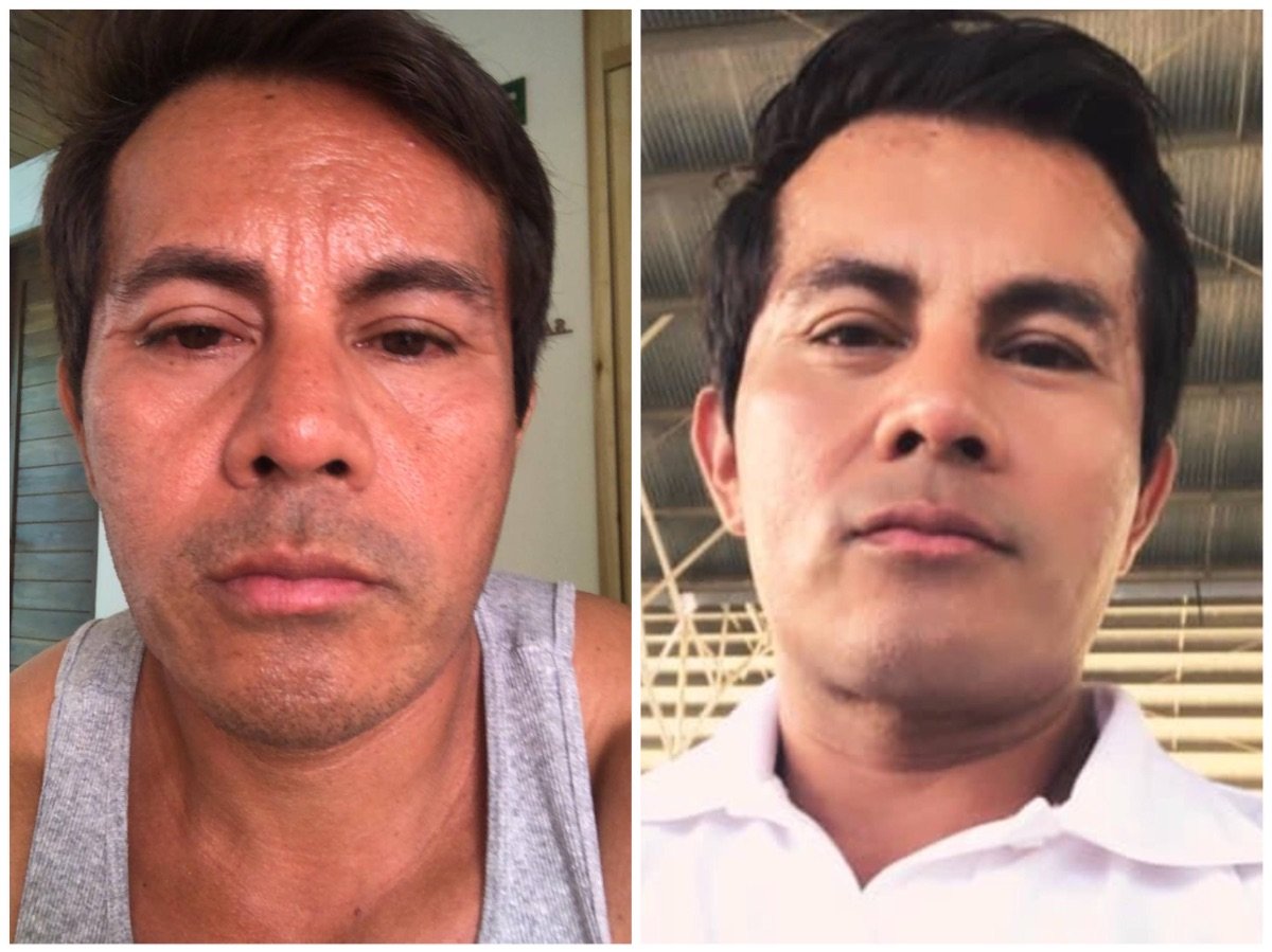 نتائج قبل وبعد علاج تجديد الشباب بالخلايا الجذعية في عيادة Juventa Regenerative Medicine