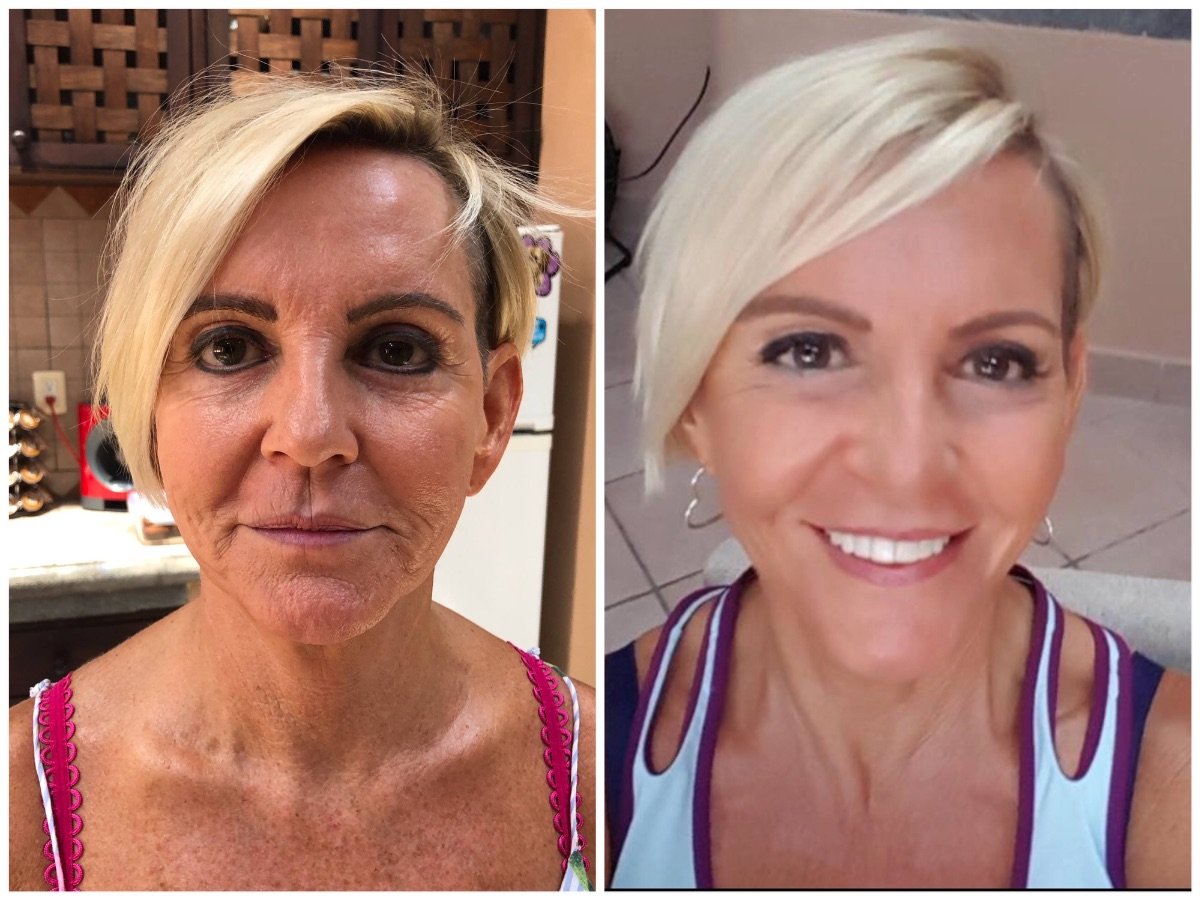 نتائج قبل وبعد علاج تجديد الخلايا الجذعية في عيادة Juventa Regenerative Medicine