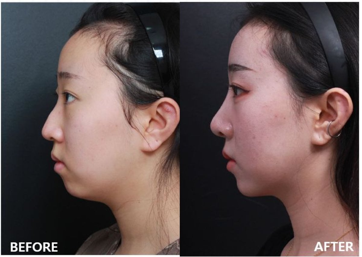 نتائج قبل وبعد زراعة الذقن في VG Plastic Surgery، تحسين شكل الذقن والملامح