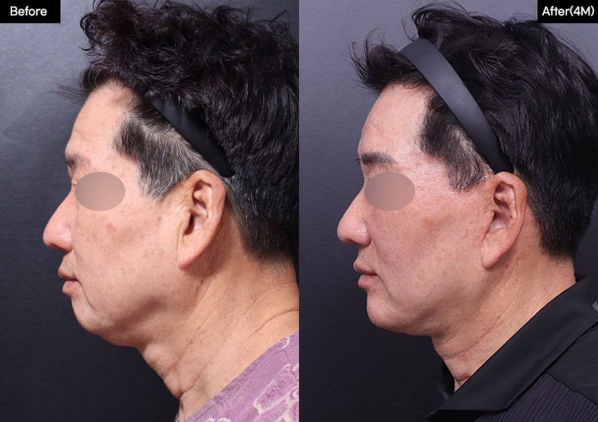 نتائج قبل وبعد زراعة الذقن في VG Plastic Surgery، تحسين شكل الذقن والملف الجانبي
