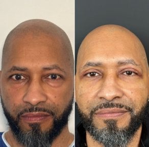 Vorher-nachher-Ergebnis Oberlidstraffung bei Dr. Safa Manav Clinic, verjüngte Augenpartie