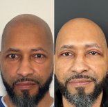 Vorher-nachher-Ergebnis Oberlidstraffung bei Dr. Safa Manav Clinic, verjüngte Augenpartie