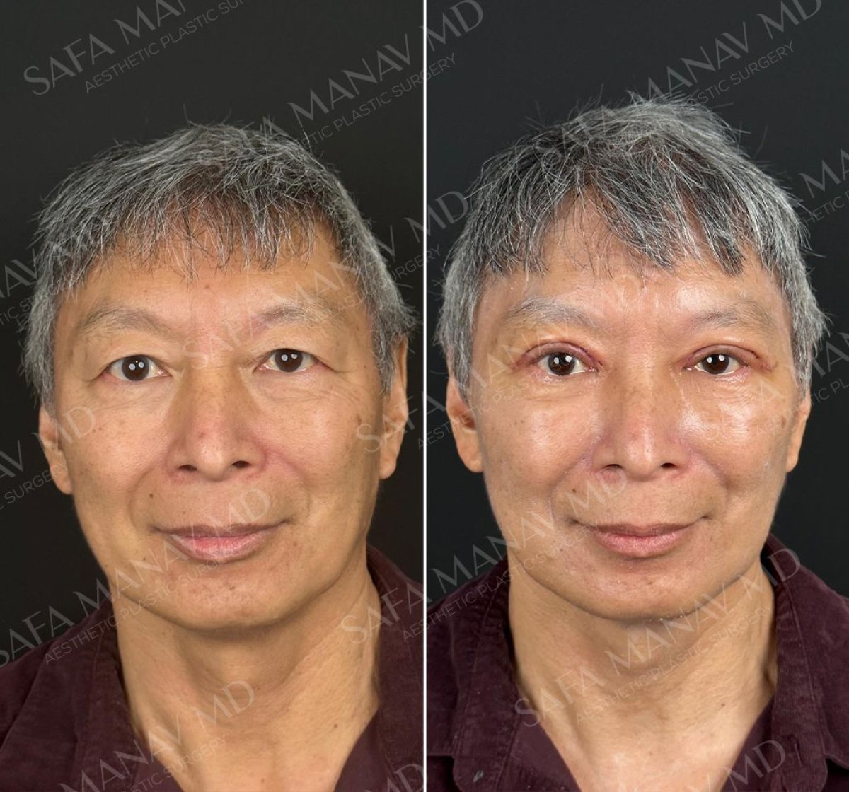 Resultados de blefaroplastia superior antes y después en Dr. Safa Manav Clinic, rejuvenecimiento