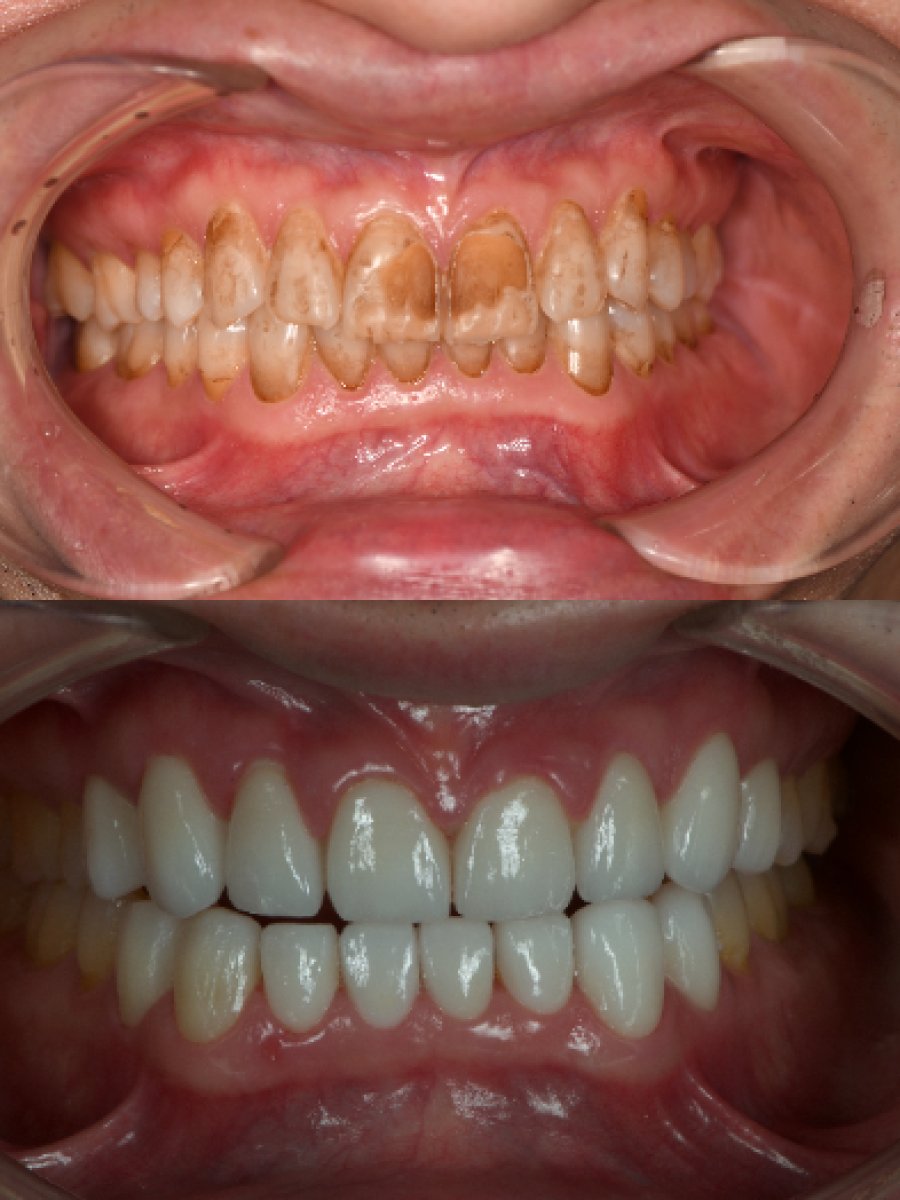 نتائج قبل وبعد قشور البورسلين في عيادة Kitcha Dental Clinic، تحول الابتسامة