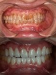 Before and after porcelain veneer results at Kitcha Dental Clinic, smile transformation