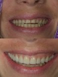 Before and after porcelain veneer results at Kitcha Dental Clinic – improved smile aesthetics