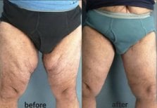 Before and after thigh lift results at ID Clinic Bangkok, improved thigh contour and firmness