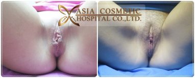 Before and after vaginoplasty results at Asia Cosmetic Hospital, improved vaginal appearance