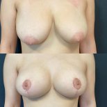 Before and after breast implant revision results at Lokman Hekim Istanbul Hospital