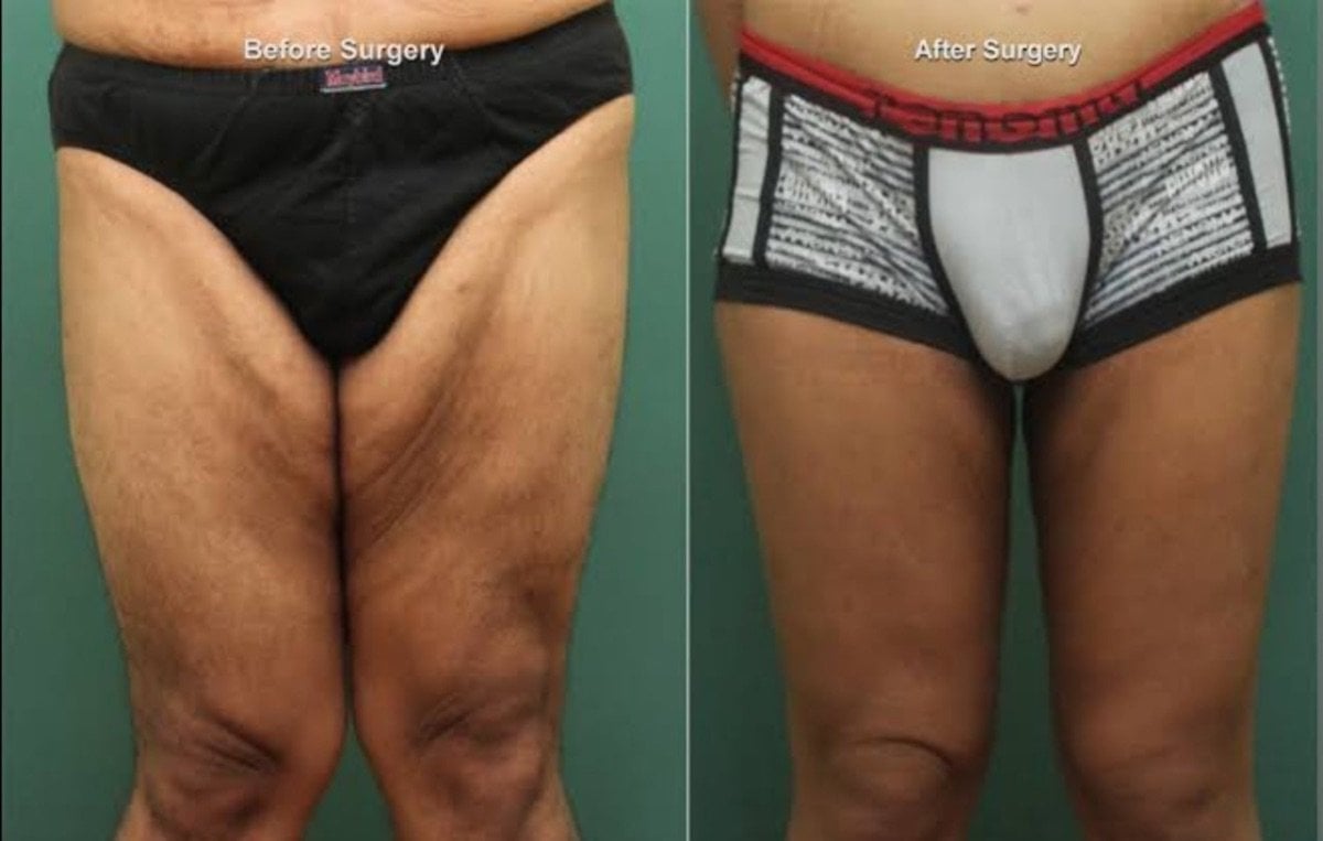 Resultados de lifting de muslos antes y después en ID Clinic Bangkok, contorno mejorado