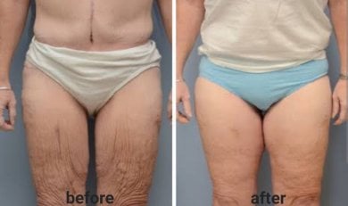 Before and after thigh lift results at ID Clinic Bangkok – smoother, firmer thigh contour