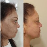 Ultherapy Vorher-Nachher-Ergebnisse bei Medical Park Antalya, Gesichtsstraffung