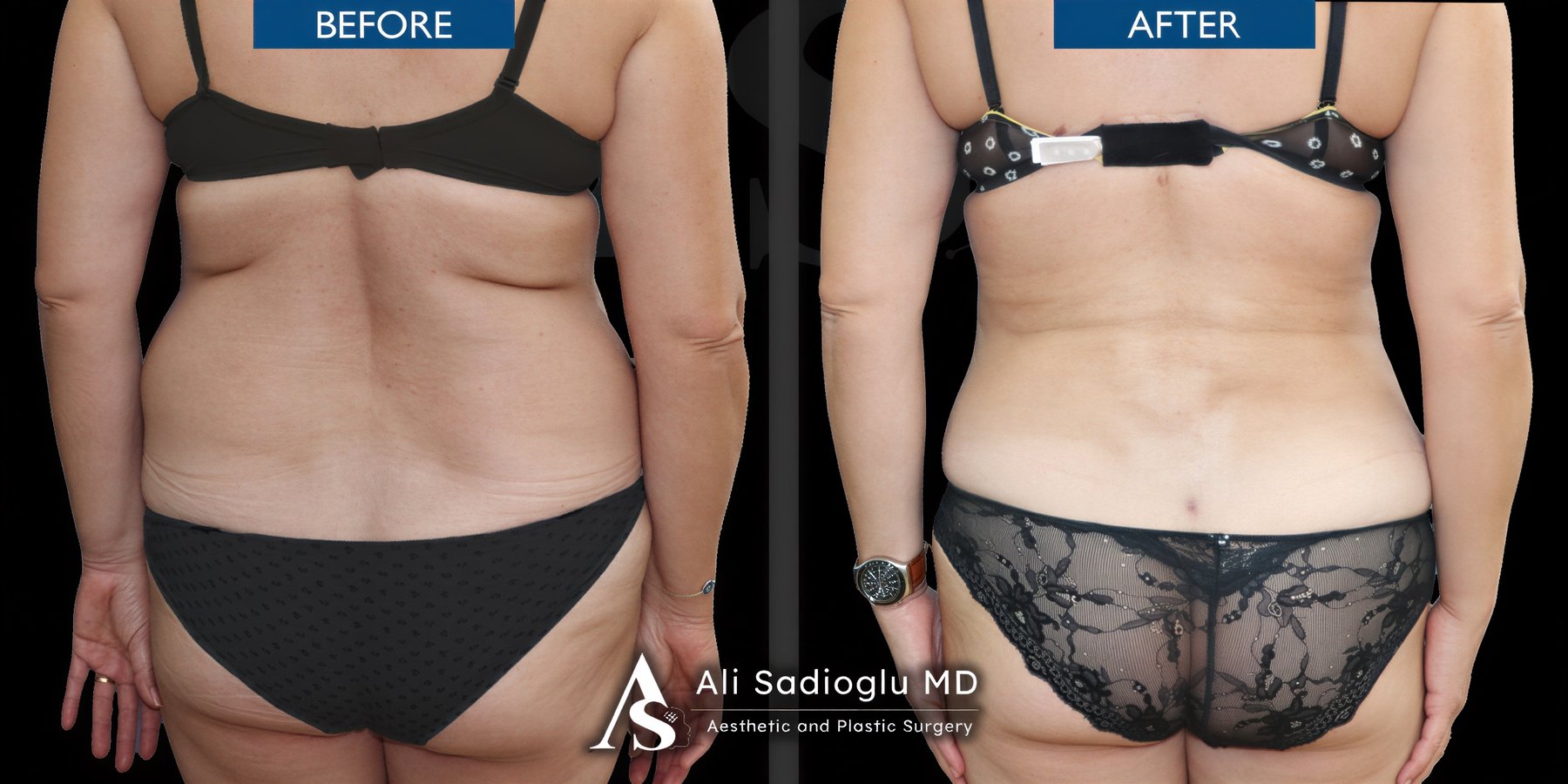 Resultados de liposucción de espalda antes y después en Dr. Safa Manav Clinic, mejor contorno