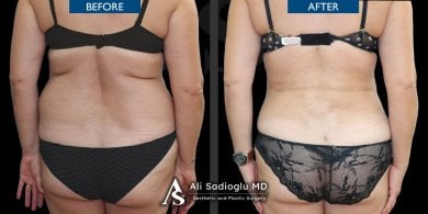 Before and after back liposuction results at Dr. Safa Manav Clinic, improved body contour