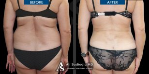 Before and after back liposuction results at Dr. Safa Manav Clinic, improved body contour