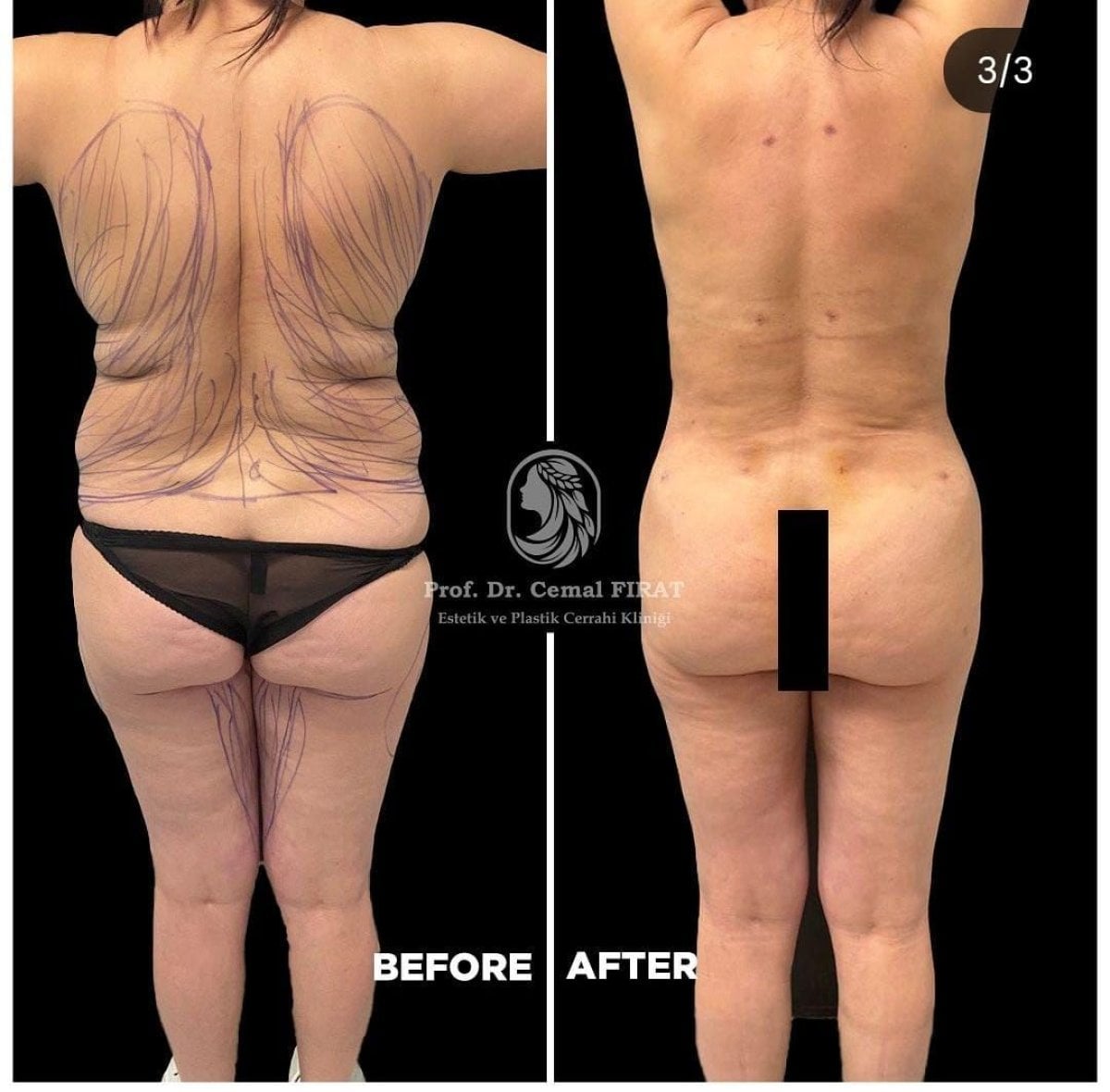 Resultados de liposucción de espalda antes y después en Medical Park Antalya Hospital Complex, contorno corporal