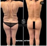 Vorher-nachher-Ergebnisse der Rückenliposuktion im Medical Park Antalya Hospital Complex, Körperkontur