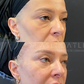 Facelift Vorher-Nachher-Ergebnisse in Liv Hospital Ulus, sichtbare Verjüngung
