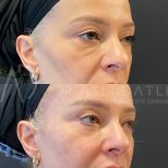 Facelift Vorher-Nachher-Ergebnisse in Liv Hospital Ulus, sichtbare Verjüngung