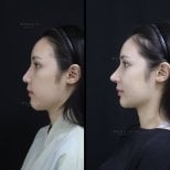 Before and after rhinoplasty result at Wansiri Hospital, improved nose profile and contour