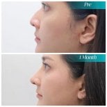 Before and after rhinoplasty results at Wansiri Hospital, nose reshaping after 1 month