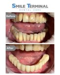 Результаты до и после имплантации зубов в Smile Terminal Dental Care, улучшены нижние зубы