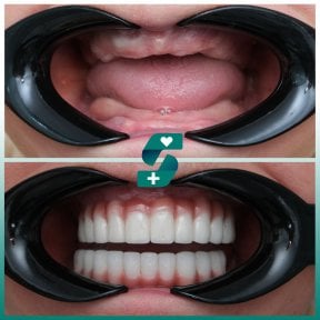 Before and after All-on-4 dental implants result at Soraca Med, full smile restoration