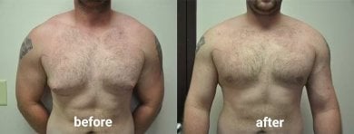 Before and after Vaser liposuction results for male chest contour at ID Clinic Bangkok