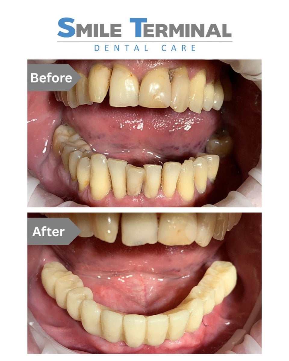 Resultados de implantes dentales antes y después en Smile Terminal Dental Care, mejora dental inferior