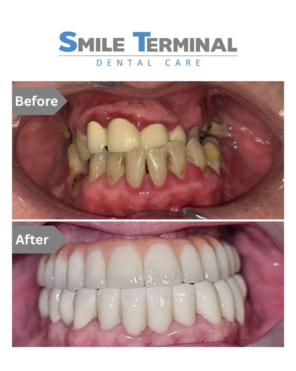 Resultados antes y después de implantes dentales en Smile Terminal Dental Care – sonrisa restaurada