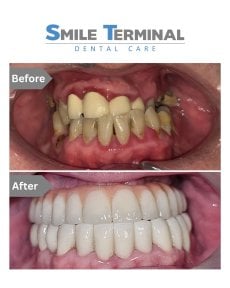 Before and after dental implant results at Smile Terminal Dental Care – restored smile transformation